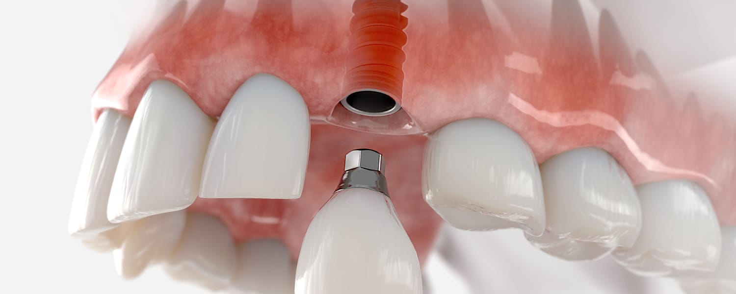 Dental Implants Normal IL