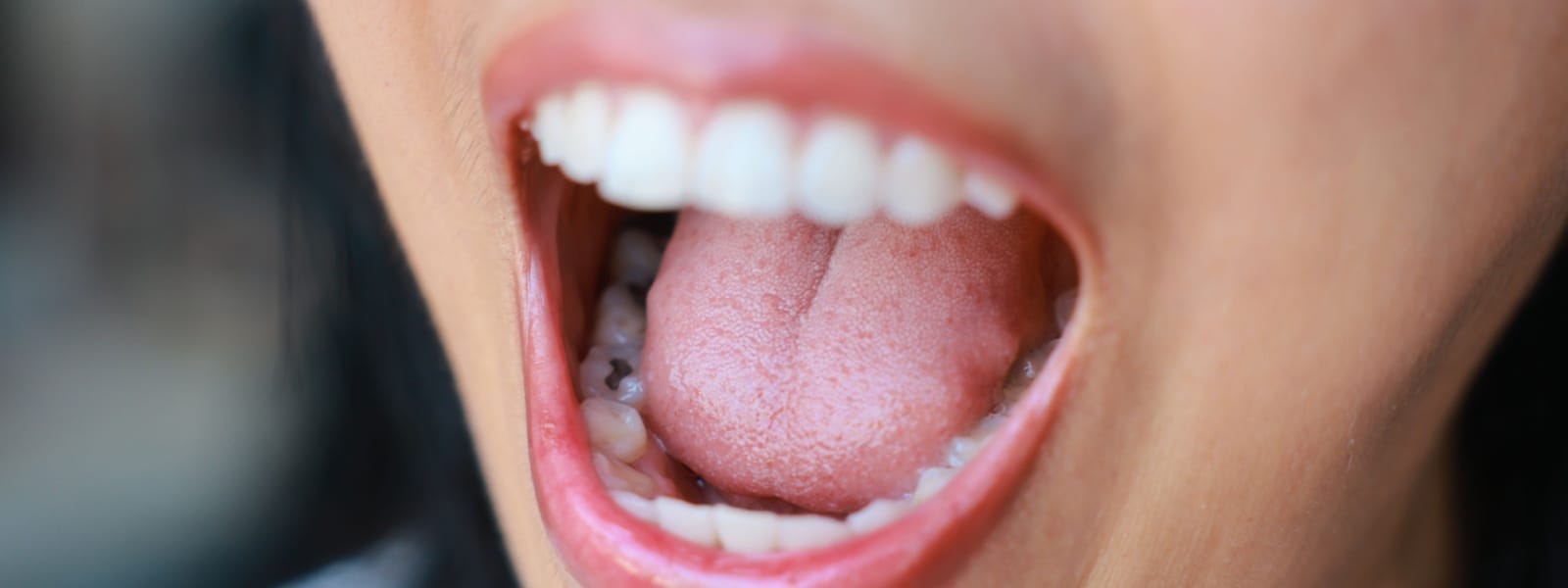 Tooth Fillings Bloomington, IL