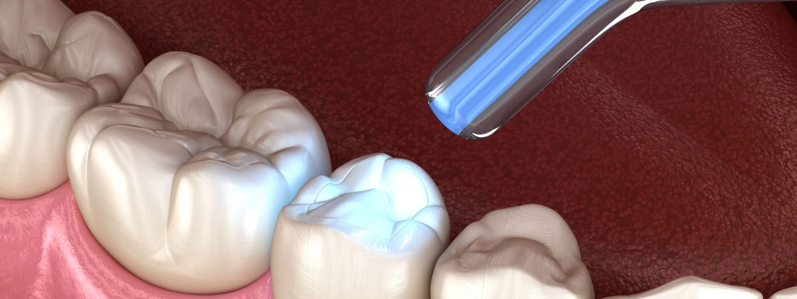 Tooth Fillings Normal, IL