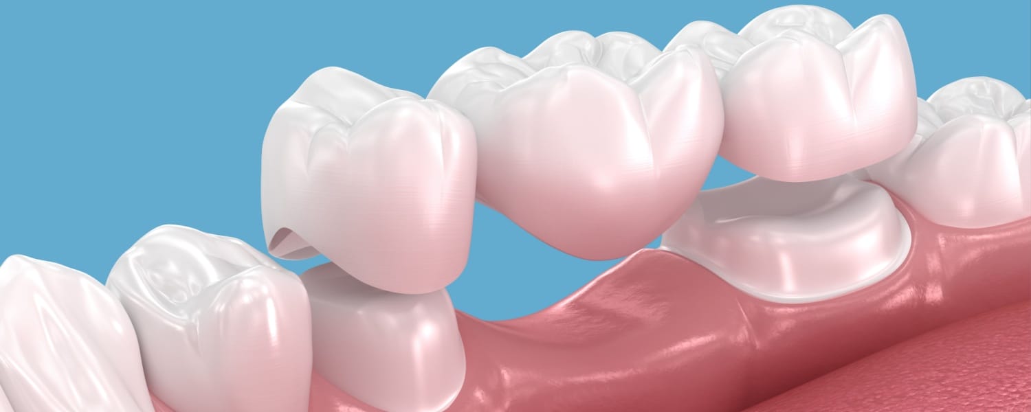 Dental Bridges in Bloomington, IL