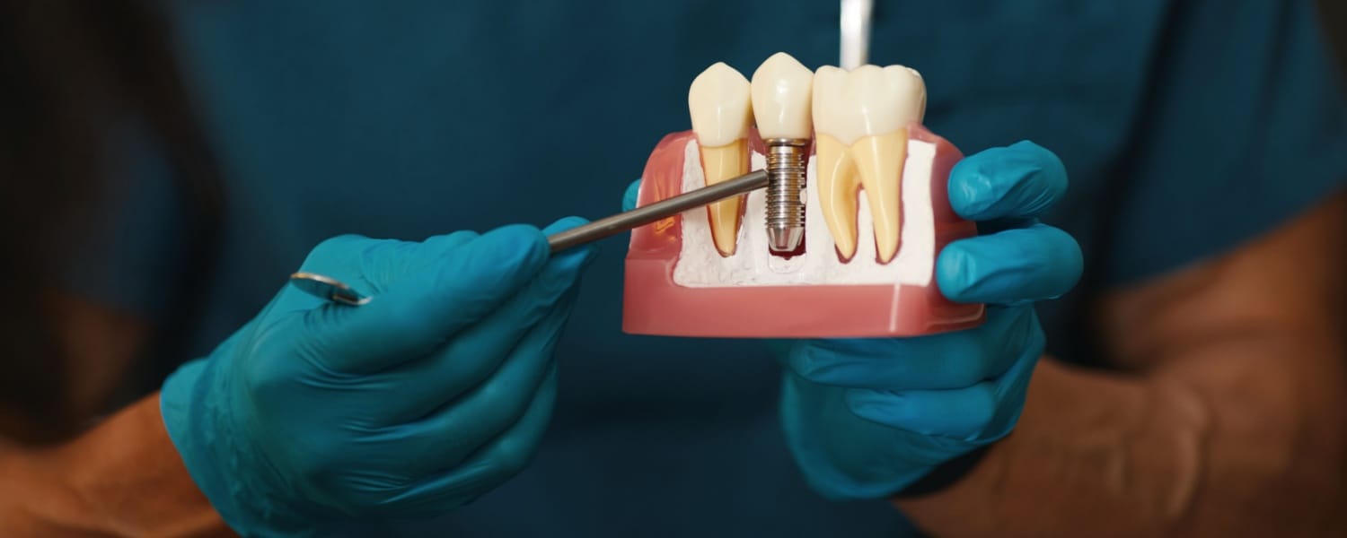 Dental Implants in Bloomington, IL