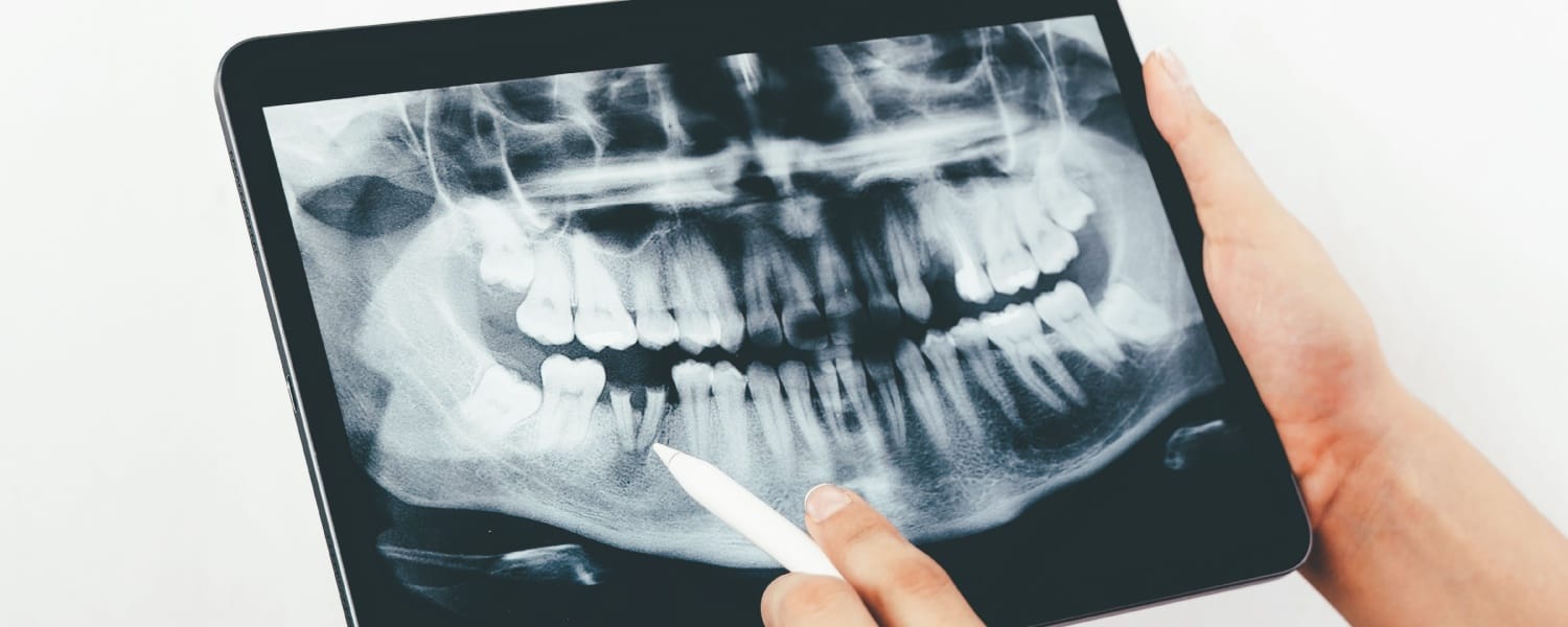 Digital X-Rays in Bloomington, IL