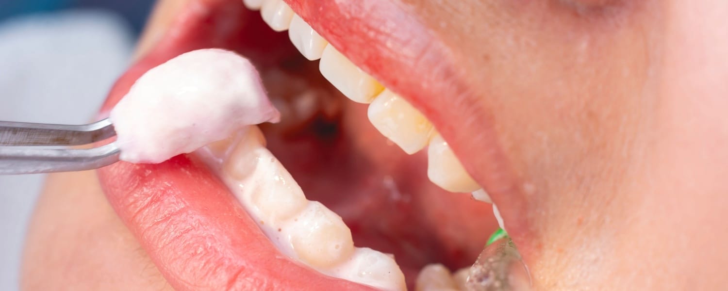 Fluoride & Sealants 1 Fluoride & Sealants in Bloomington, IL